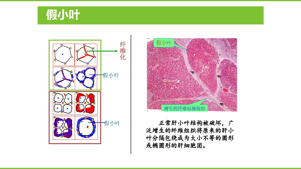肝硬化PPT课件26