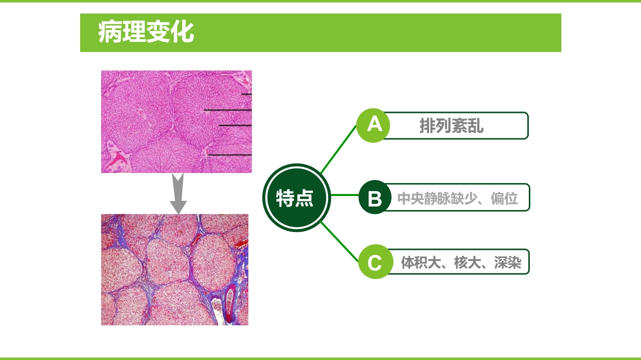 肝硬化PPT课件27