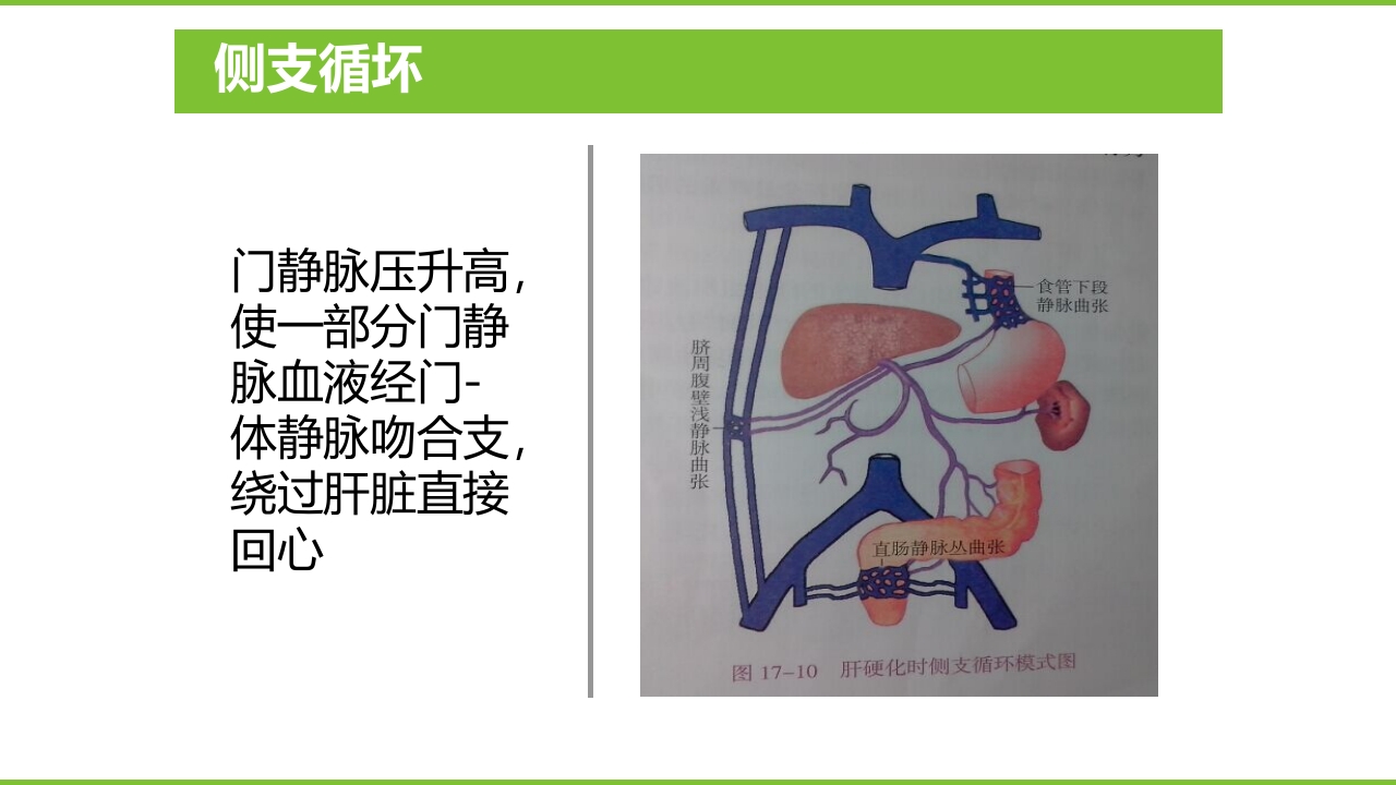 肝硬化PPT课件38