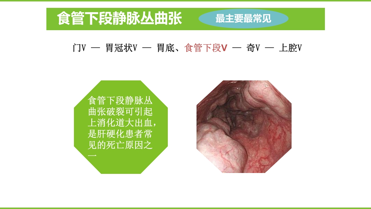 肝硬化PPT课件39