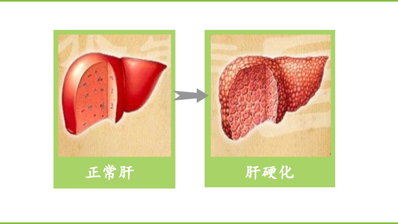 肝硬化PPT课件3