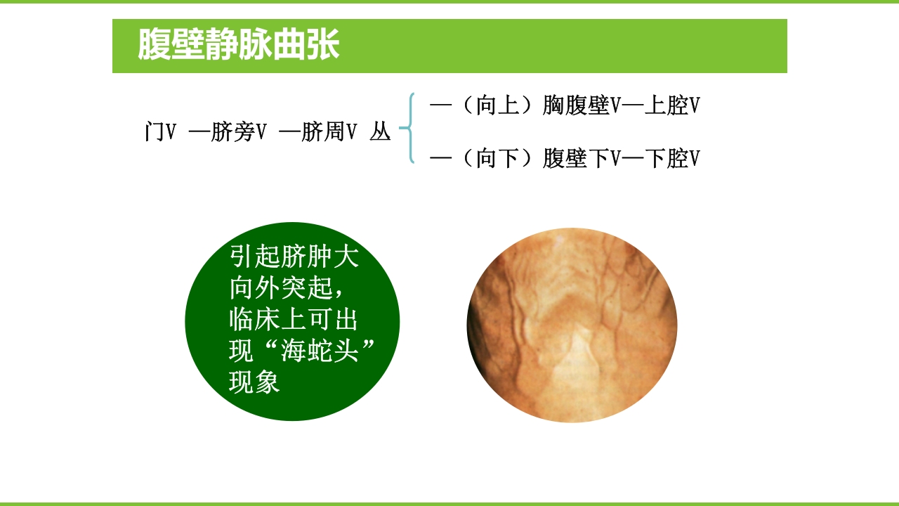 肝硬化PPT课件41