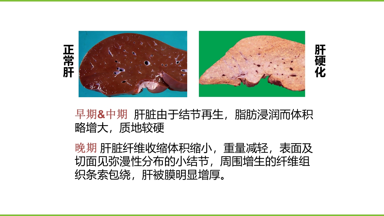 肝硬化PPT课件4
