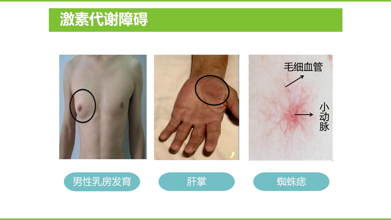 肝硬化PPT课件54