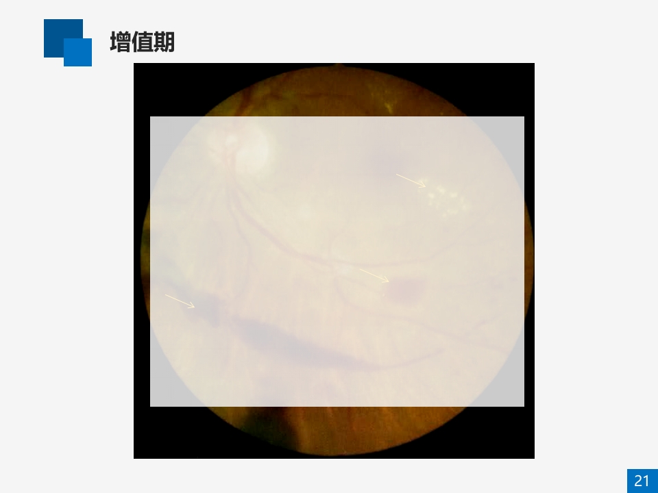 糖尿病视网膜病变病例讨论PPT课件21