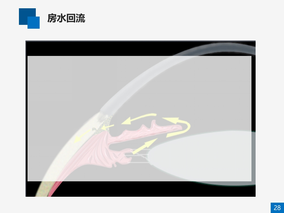 糖尿病视网膜病变病例讨论PPT课件28