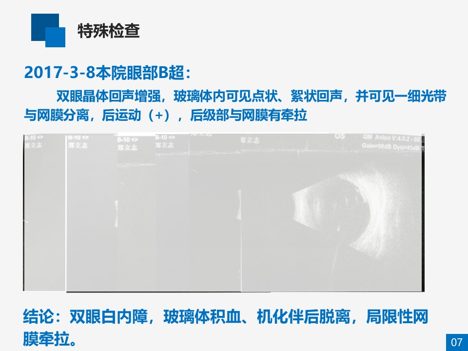 糖尿病视网膜病变病例讨论PPT课件7