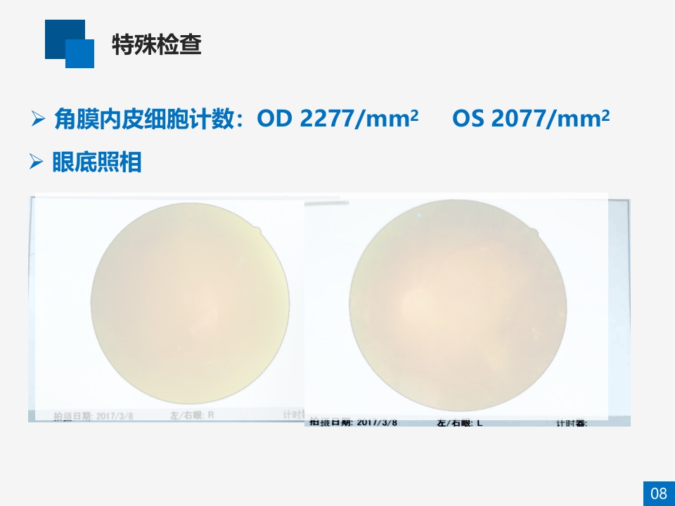 糖尿病视网膜病变病例讨论PPT课件8
