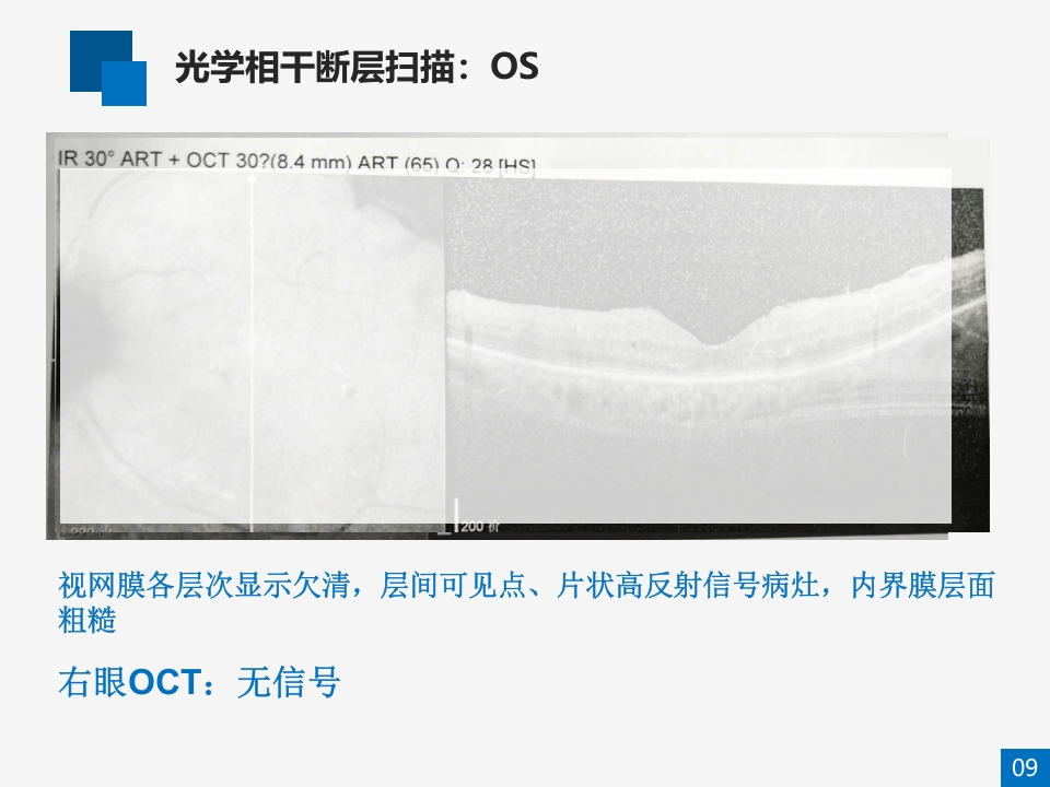 糖尿病视网膜病变病例讨论PPT课件9