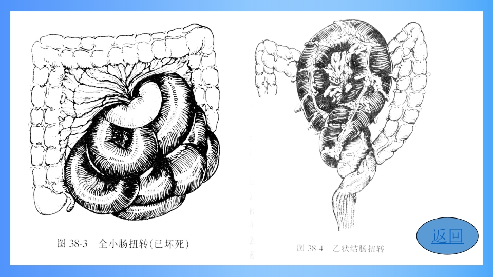 急性肠梗阻PPT课件10