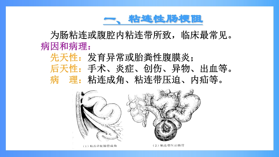 急性肠梗阻PPT课件23