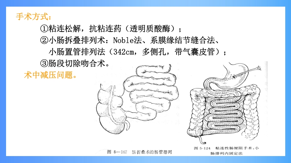 急性肠梗阻PPT课件25