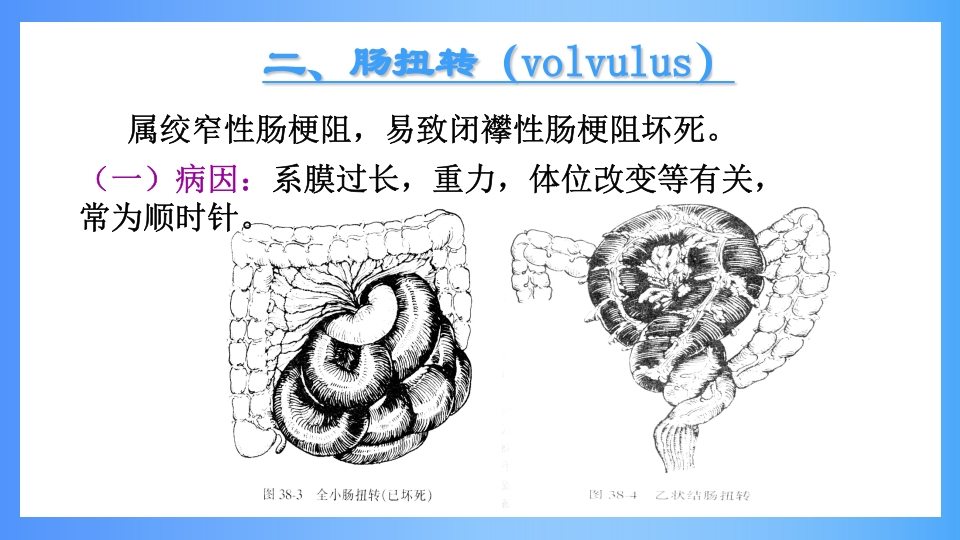 急性肠梗阻PPT课件26