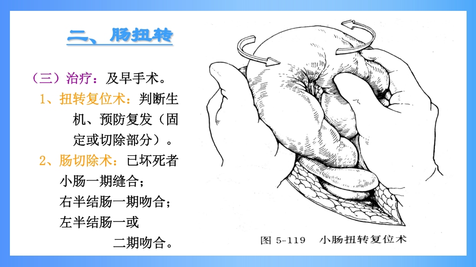 急性肠梗阻PPT课件28