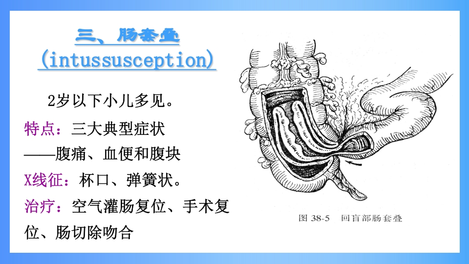 急性肠梗阻PPT课件30