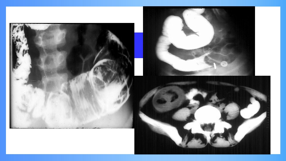 急性肠梗阻PPT课件31