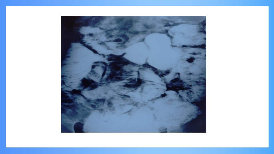 急性肠梗阻PPT课件34