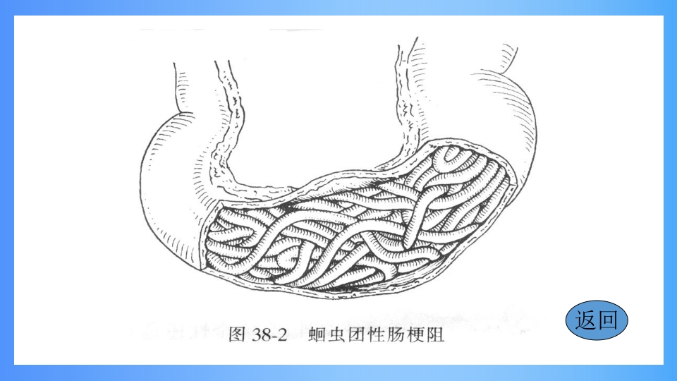 急性肠梗阻PPT课件5