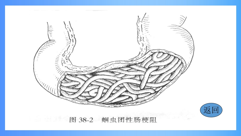 急性肠梗阻PPT课件6
