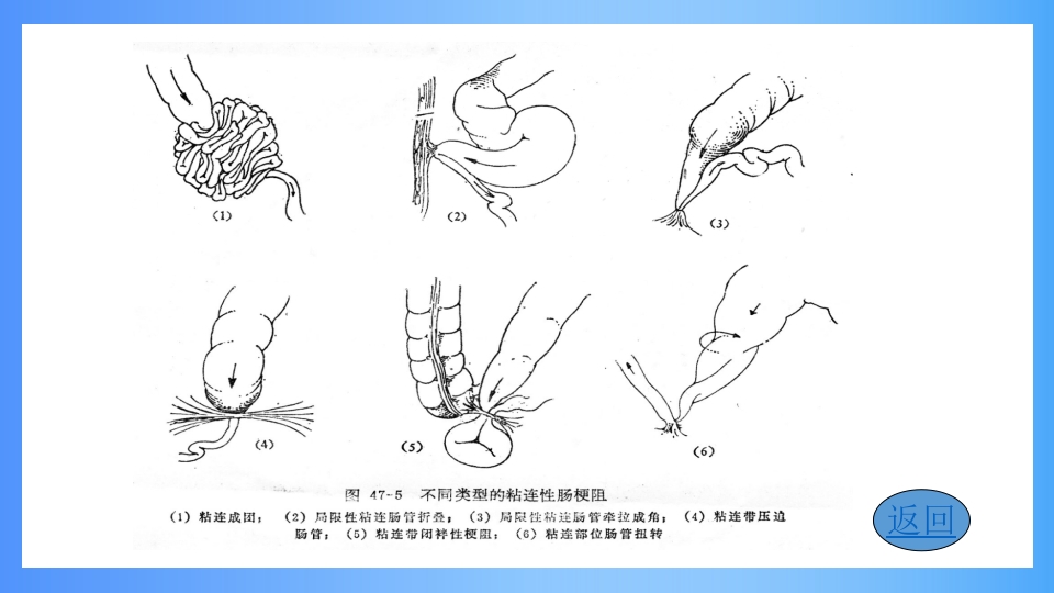 急性肠梗阻PPT课件7