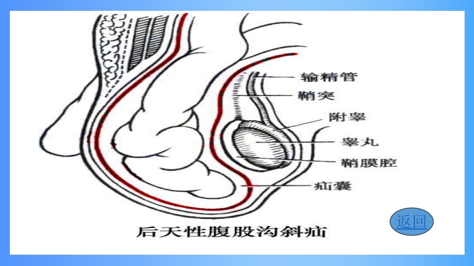 急性肠梗阻PPT课件8