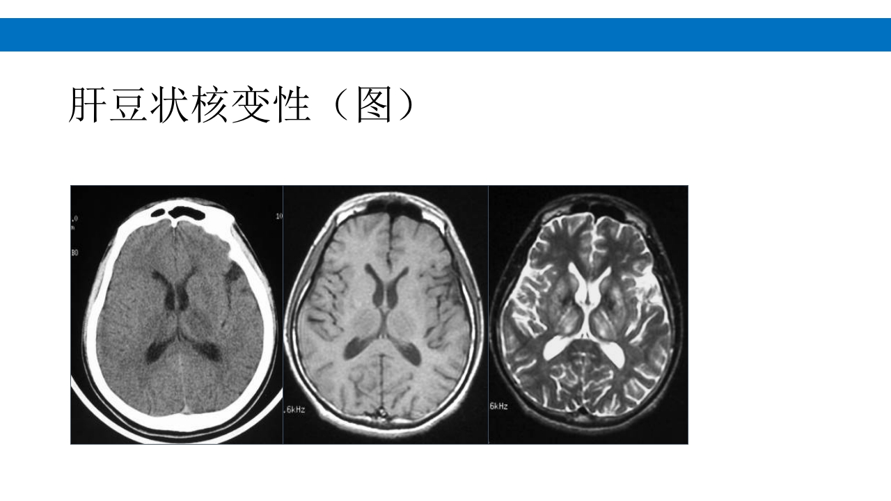 颅脑损伤的并发症及后遗症PPT课件102
