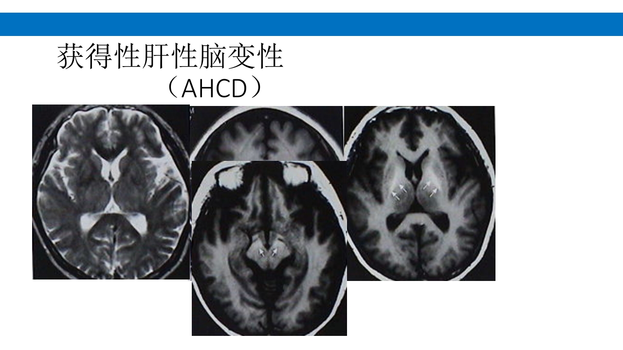 颅脑损伤的并发症及后遗症PPT课件103