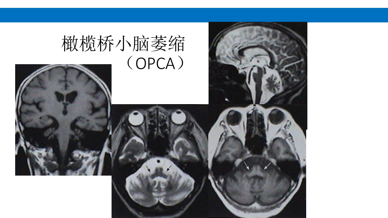 颅脑损伤的并发症及后遗症PPT课件104