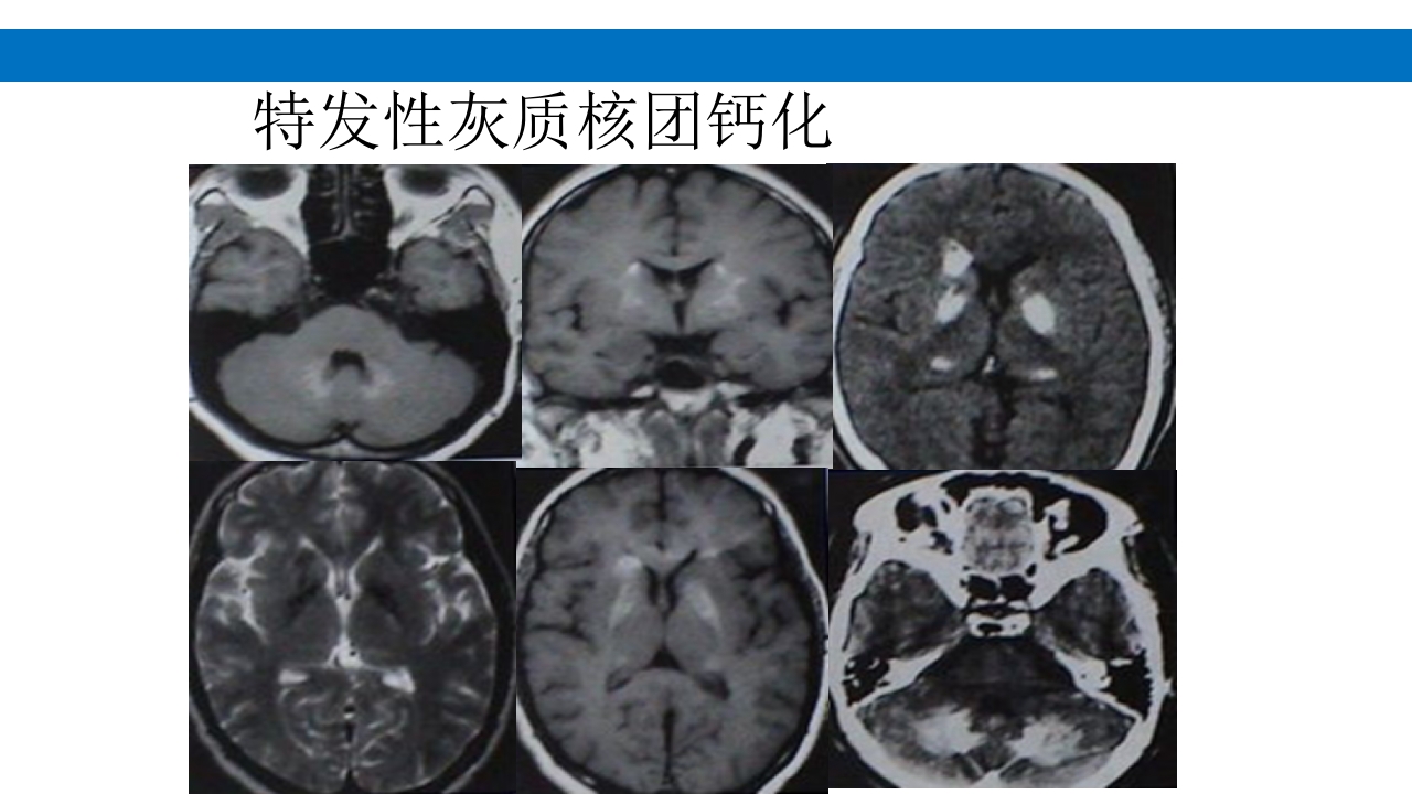 颅脑损伤的并发症及后遗症PPT课件106