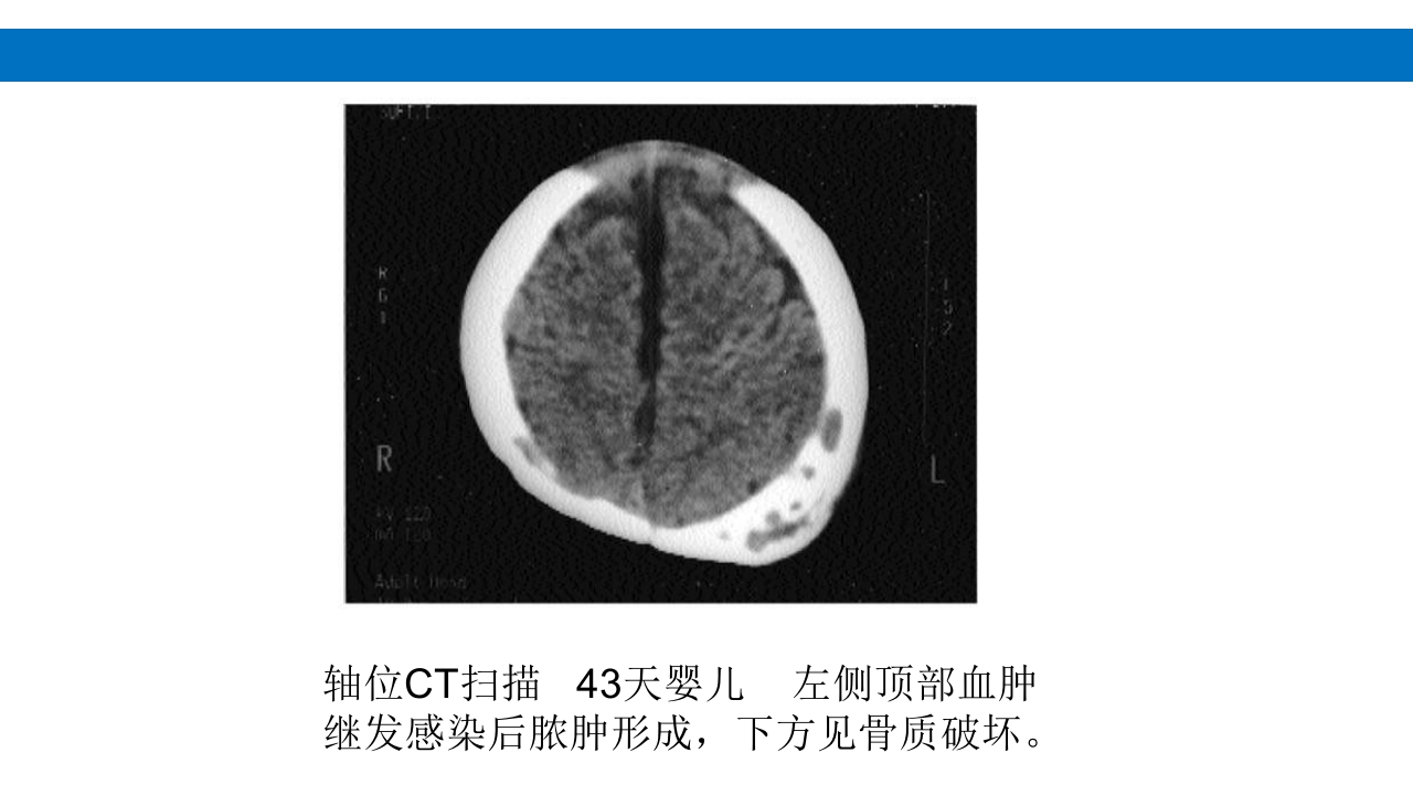 颅脑损伤的并发症及后遗症PPT课件10