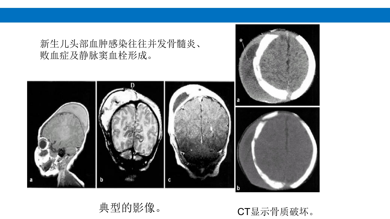 颅脑损伤的并发症及后遗症PPT课件11
