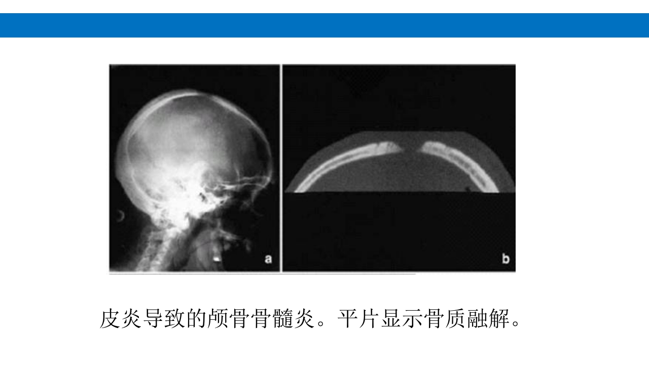 颅脑损伤的并发症及后遗症PPT课件12