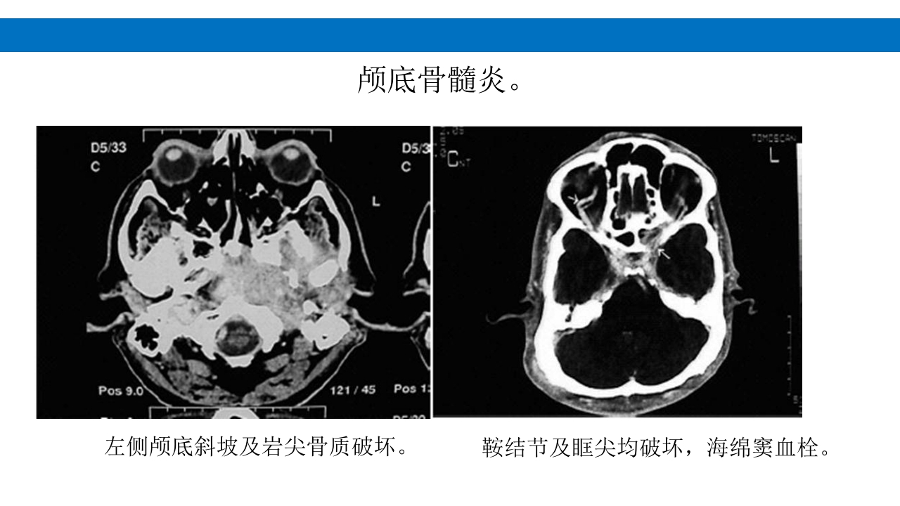 颅脑损伤的并发症及后遗症PPT课件13