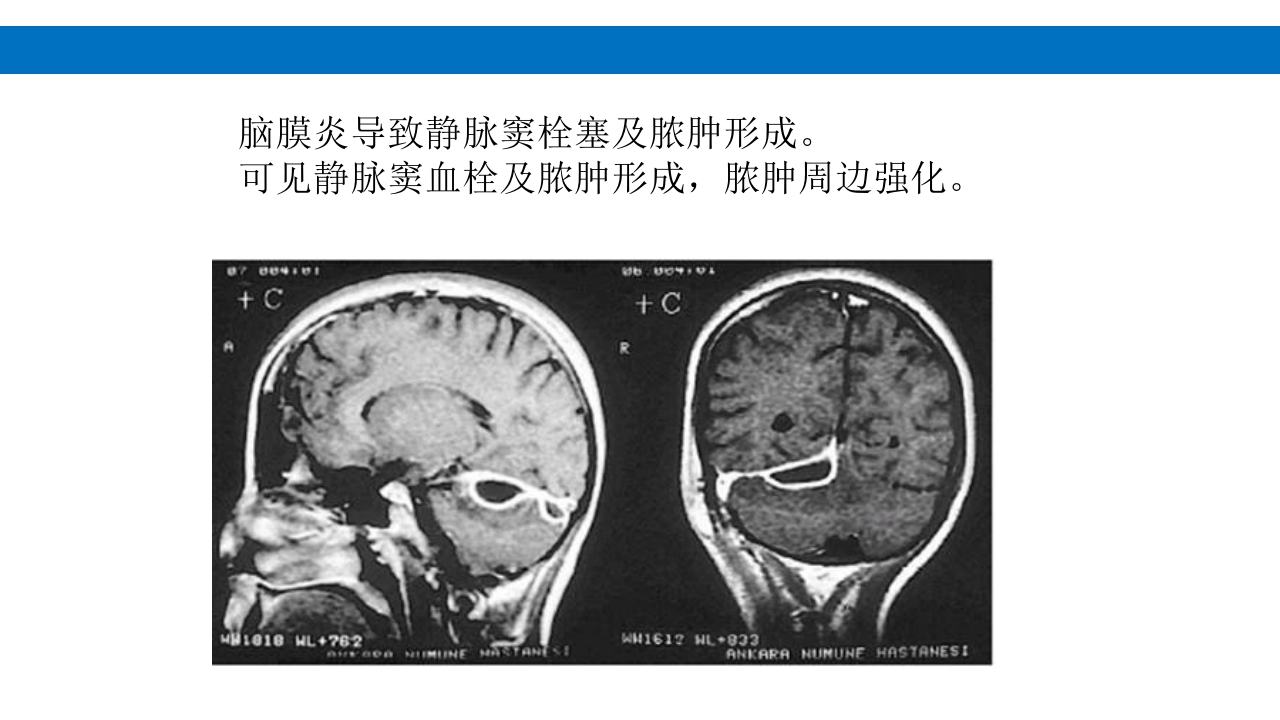 颅脑损伤的并发症及后遗症PPT课件17