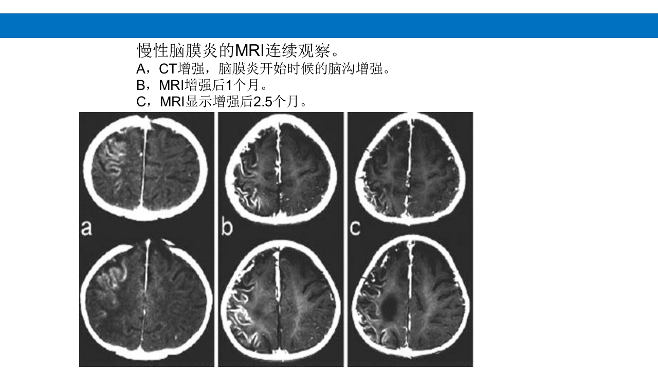 颅脑损伤的并发症及后遗症PPT课件18
