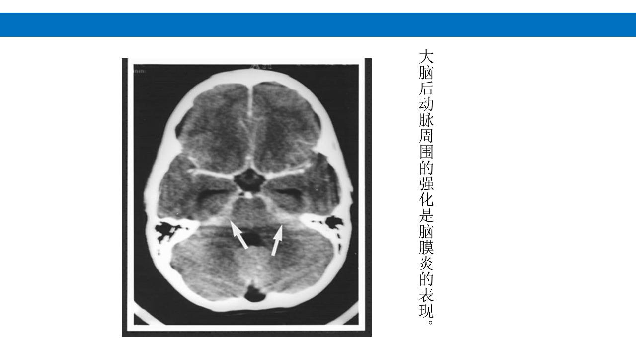 颅脑损伤的并发症及后遗症PPT课件19