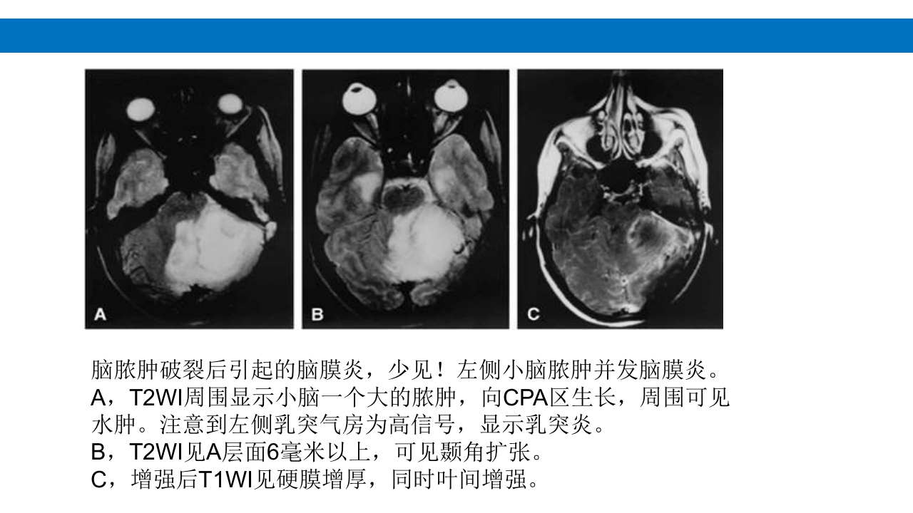 颅脑损伤的并发症及后遗症PPT课件20