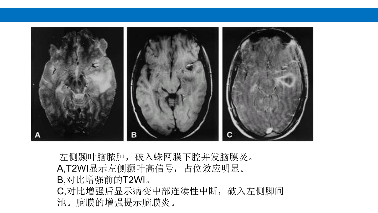颅脑损伤的并发症及后遗症PPT课件21