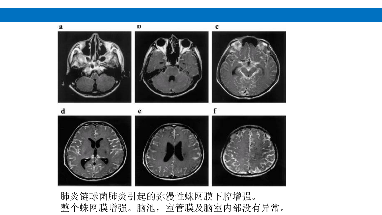 颅脑损伤的并发症及后遗症PPT课件22
