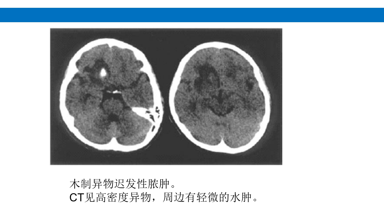 颅脑损伤的并发症及后遗症PPT课件26
