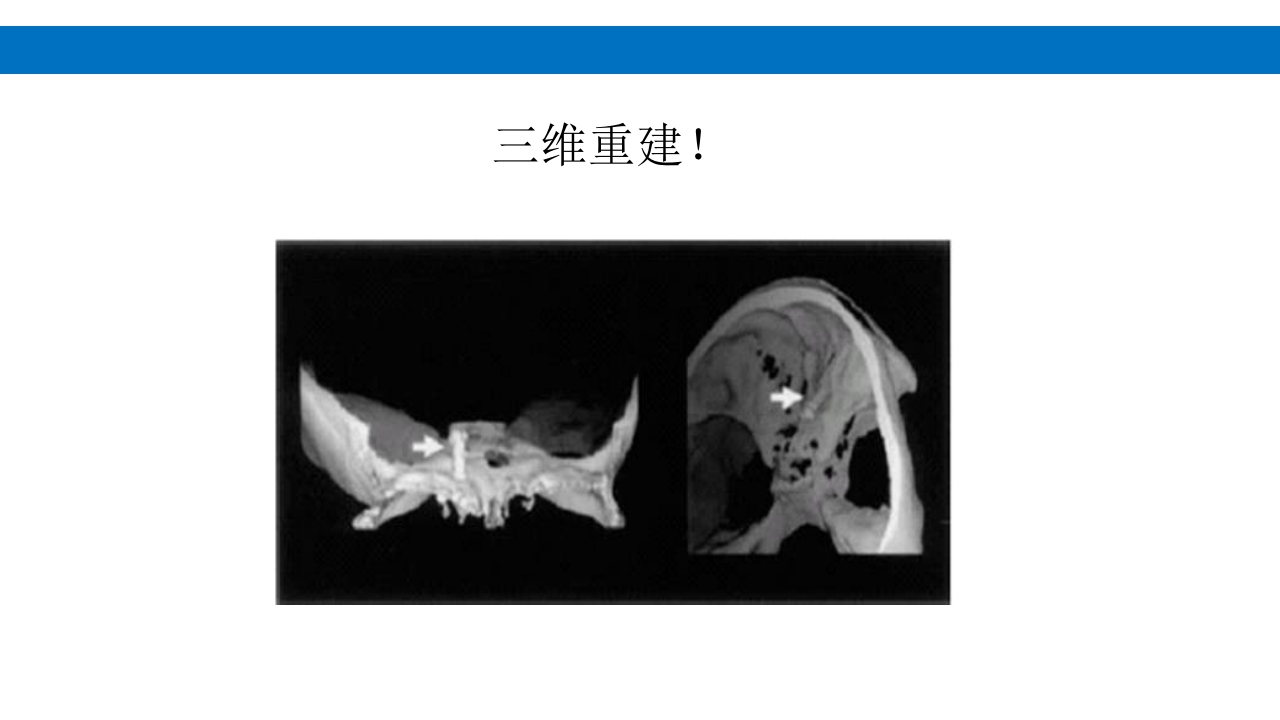 颅脑损伤的并发症及后遗症PPT课件27