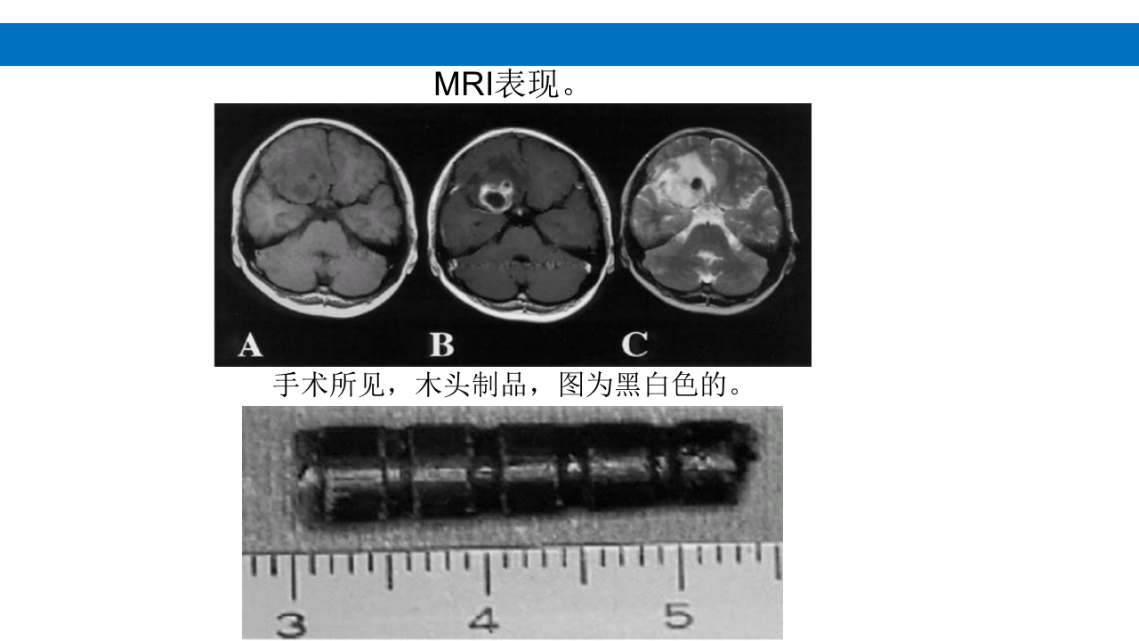 颅脑损伤的并发症及后遗症PPT课件28