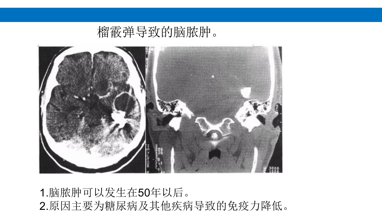 颅脑损伤的并发症及后遗症PPT课件29