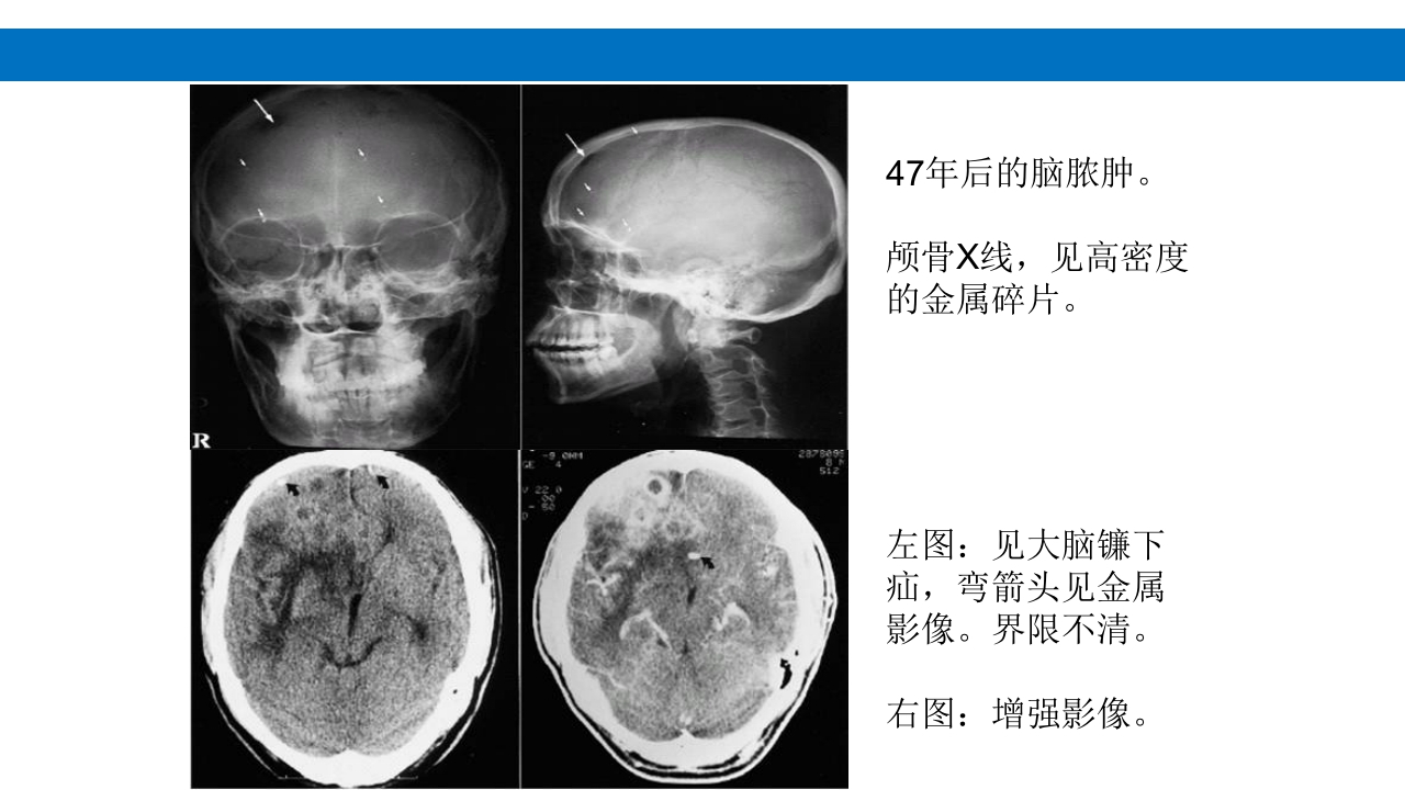 颅脑损伤的并发症及后遗症PPT课件30