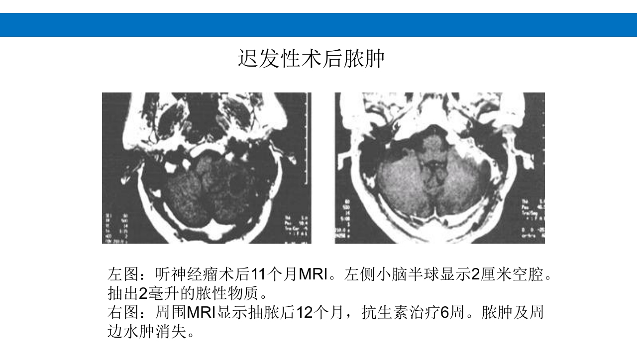 颅脑损伤的并发症及后遗症PPT课件32