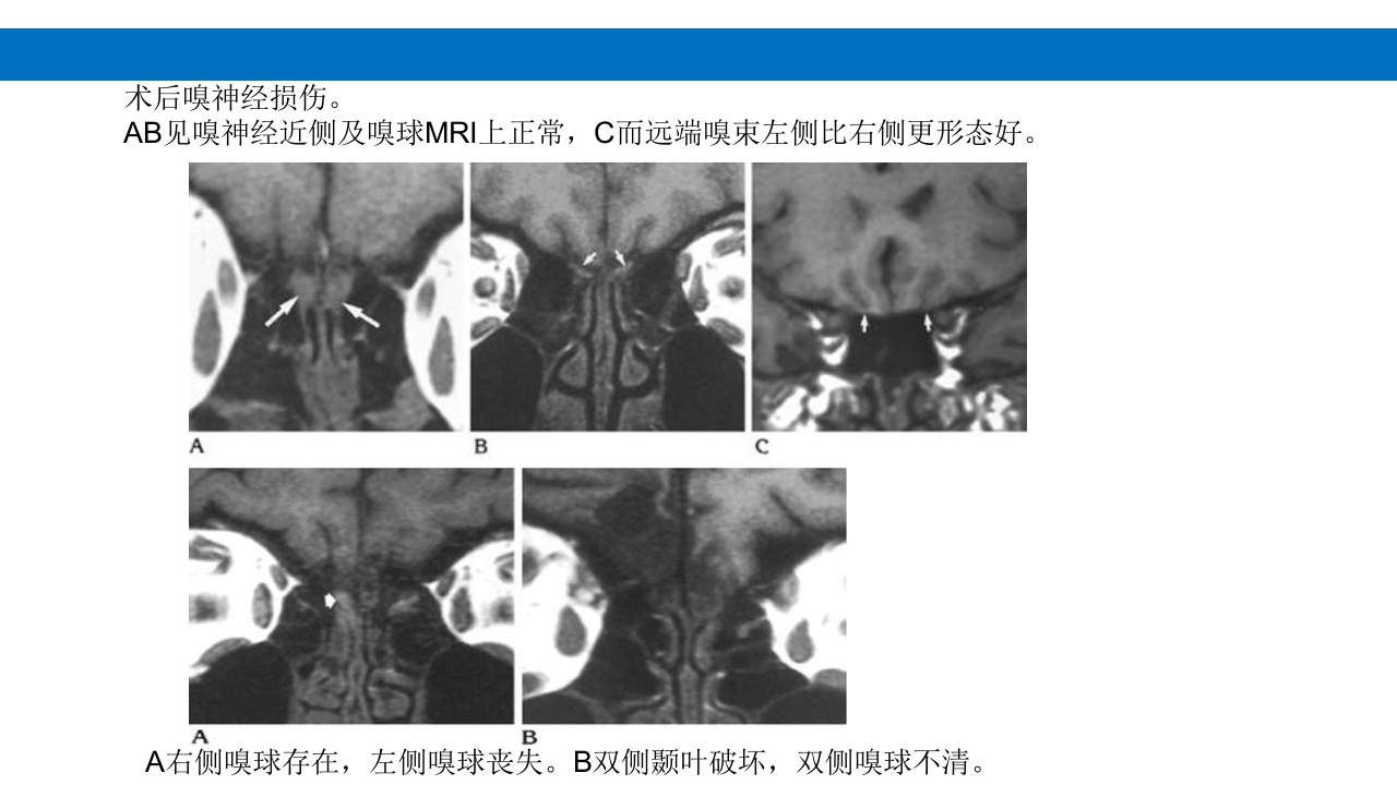 颅脑损伤的并发症及后遗症PPT课件36