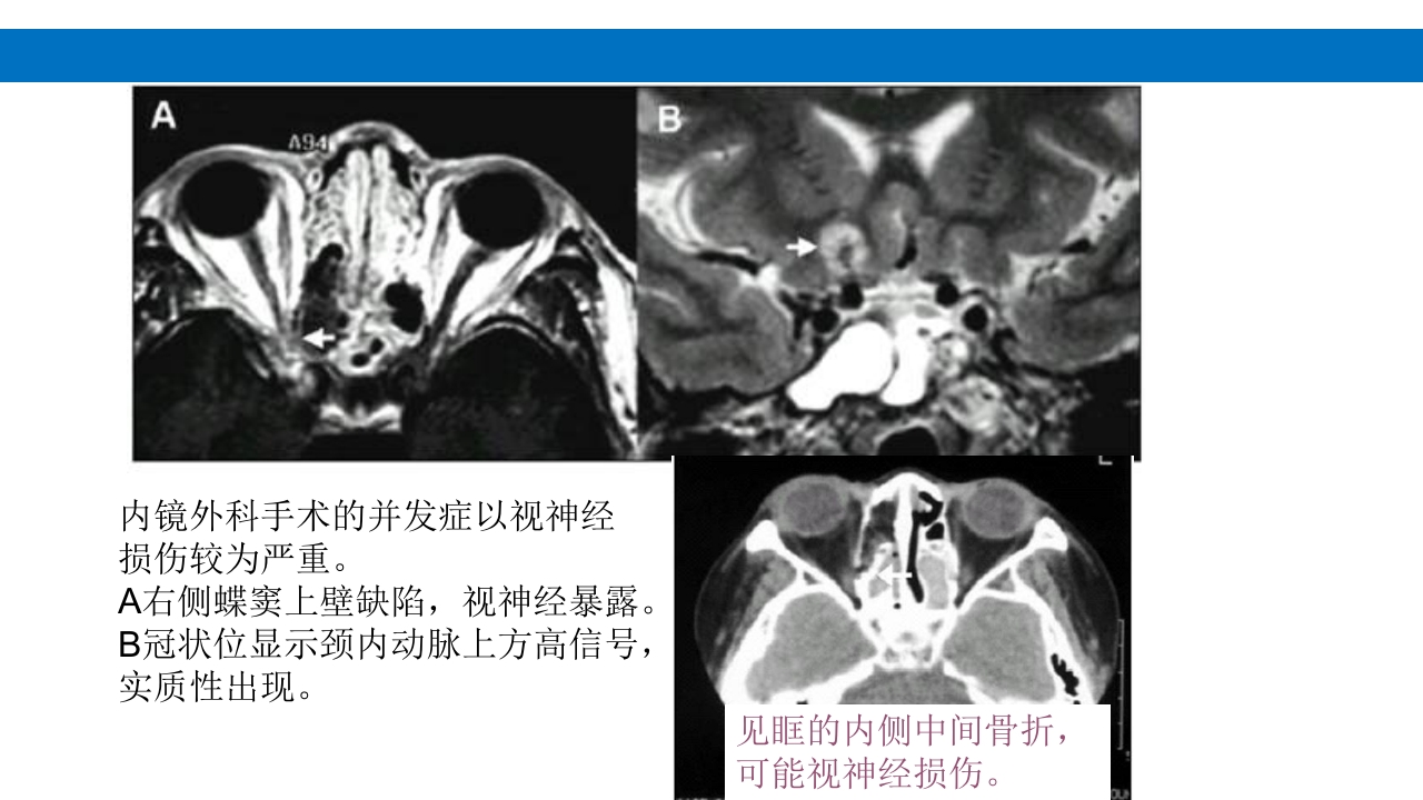颅脑损伤的并发症及后遗症PPT课件37