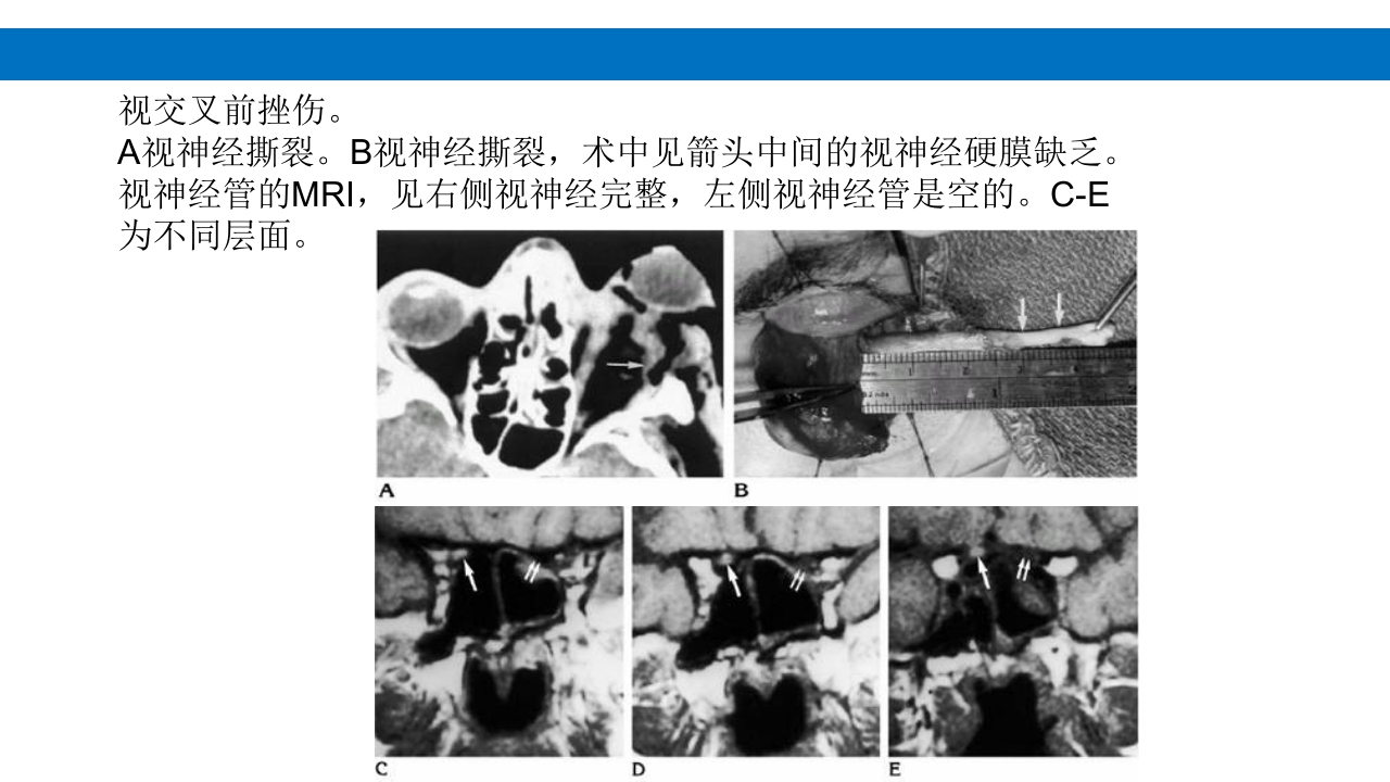 颅脑损伤的并发症及后遗症PPT课件38