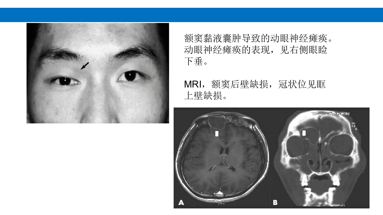 颅脑损伤的并发症及后遗症PPT课件39