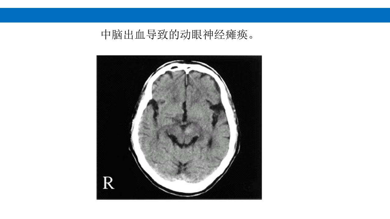 颅脑损伤的并发症及后遗症PPT课件40